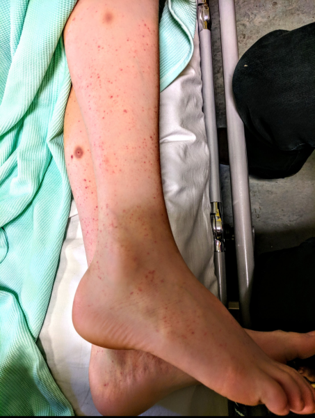 Petechiae on toddler? Photos attached