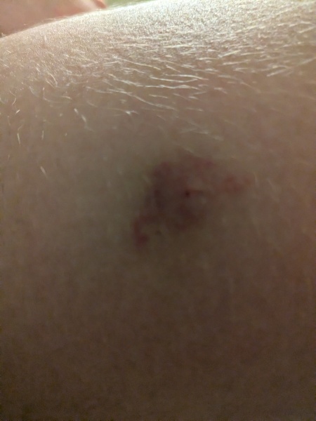 Mossi bite?