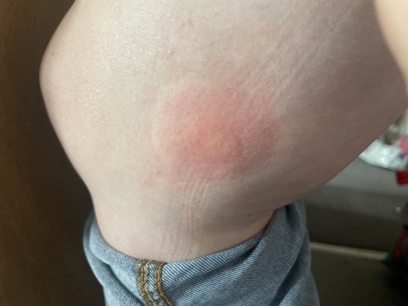 What on earth are these bites!