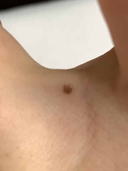 Would you worry about this mole? ☹️ Tired, anxious and fed up