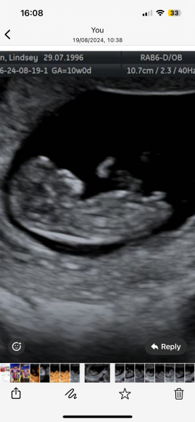 Predicting baby gender using Nub Theory 11 weeks