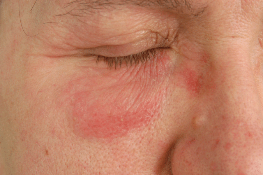 Can anyone help - swelling & dryness around eyes