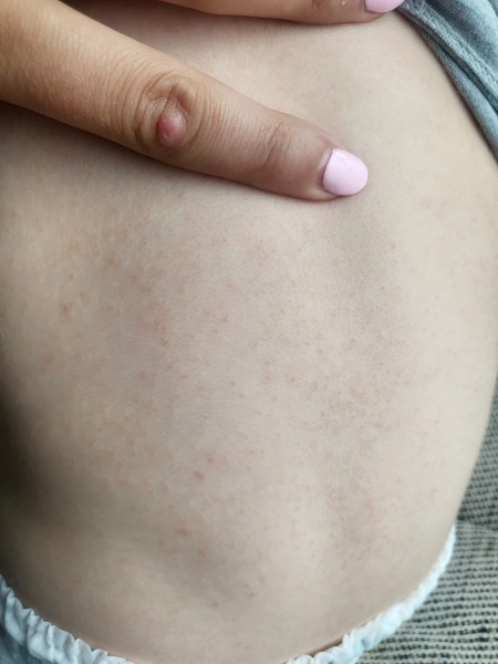 Rash and fever. Pictures!