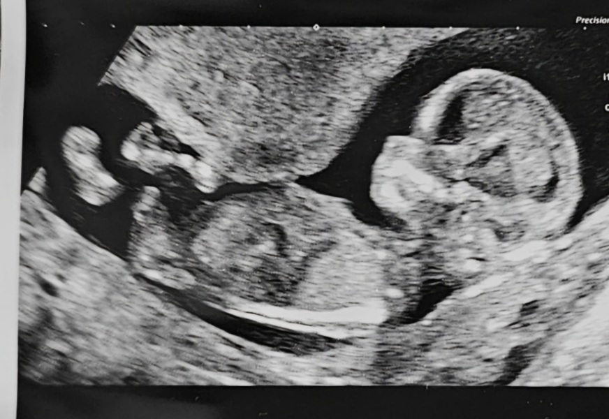 20 scan tomorrow- gender guesses