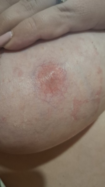 Red patch of skin on breast??