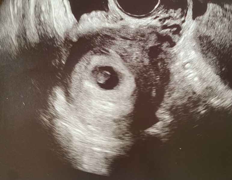 5 weeks pregnant. Due March 25. Anyone want to join?