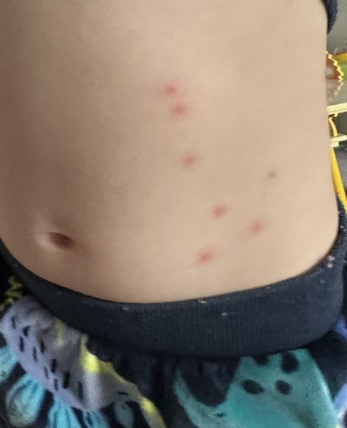 Rash on left side of 3 year olds abdomen