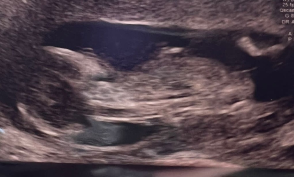 Boy or Girl? Nub theory