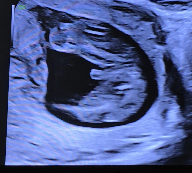 Nipt says girl, but ultrasound says boy!