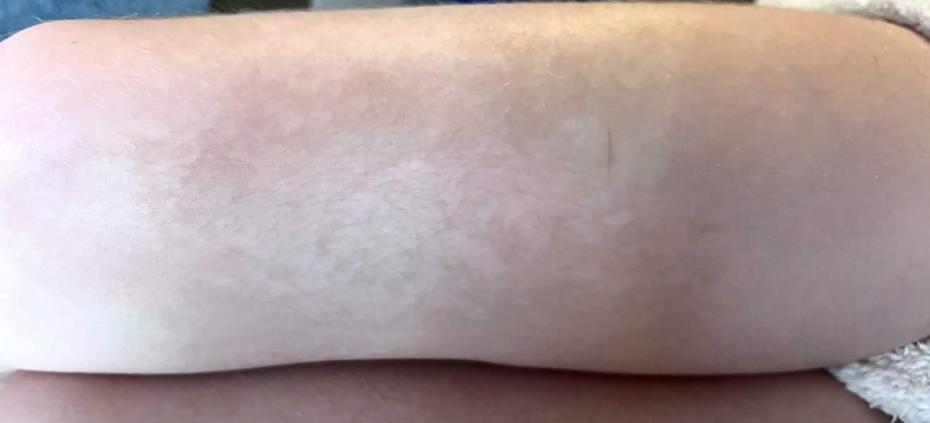 Patchy tan on child