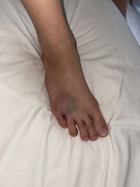 To go to ae or not for her foot?