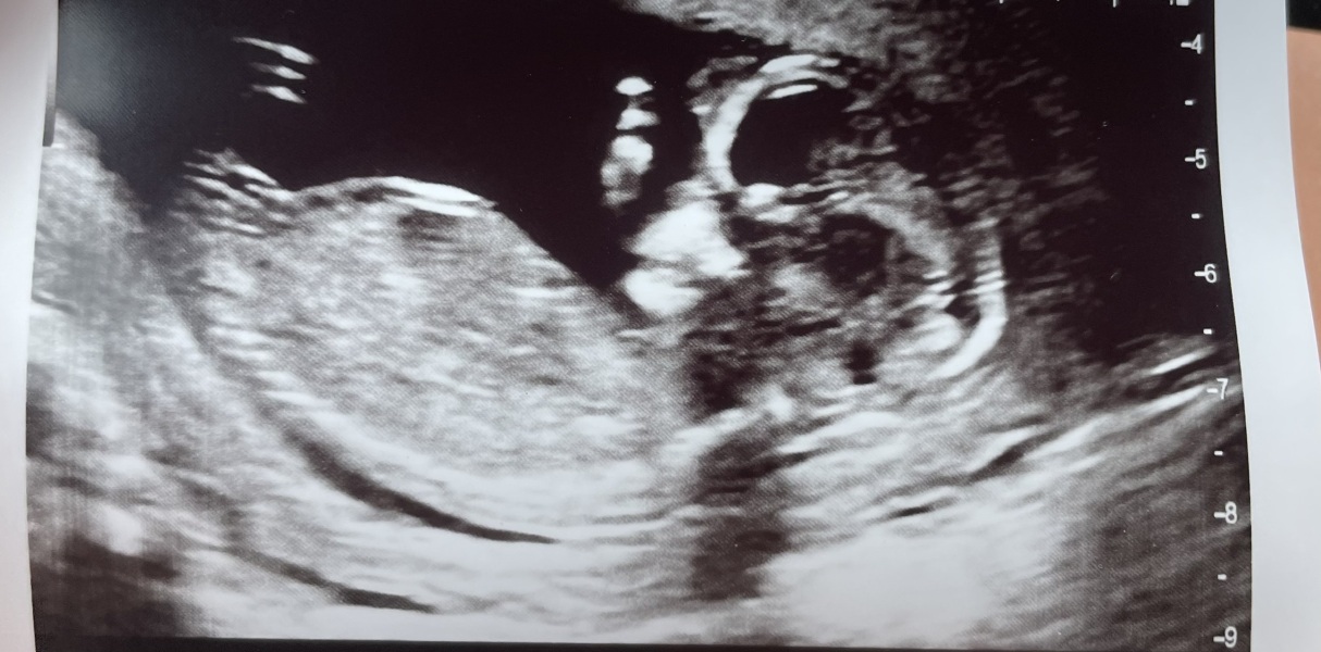 Girl or Boy predictions?