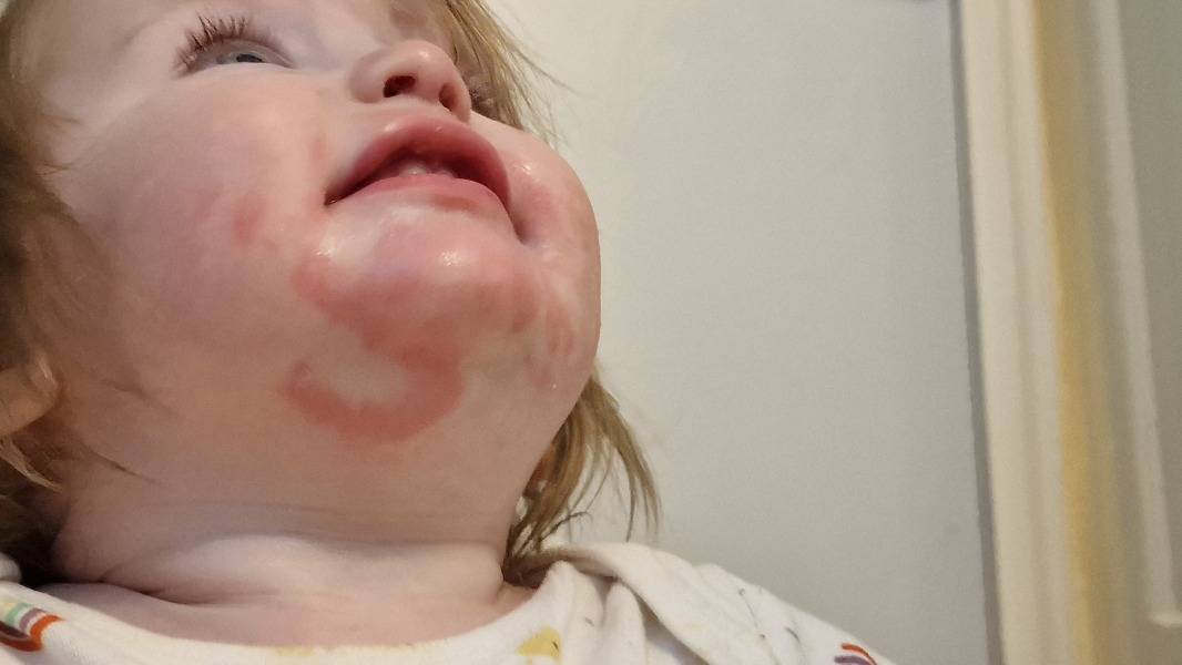 Allergies? Or just skin irritation?