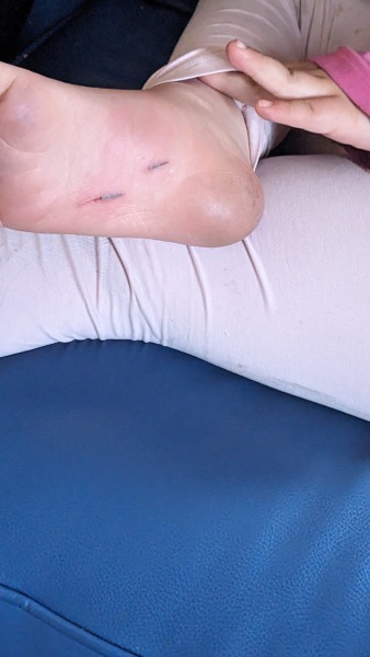 Removing splinters from uncooperative child