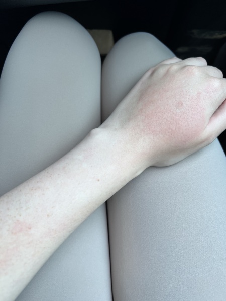 Wasp sting - swollen & painful again weeks later