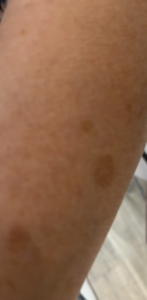 How to remove age spots on arms.