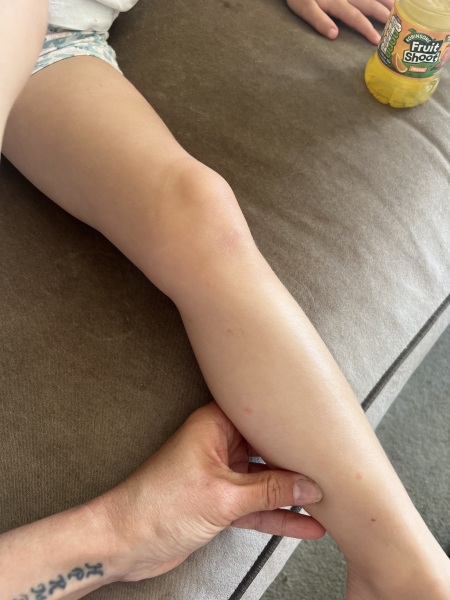 Advice Needed - Chickenpox or not?