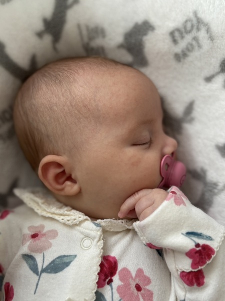 Baby acne?