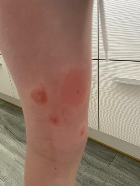 Please help keep identify these bites