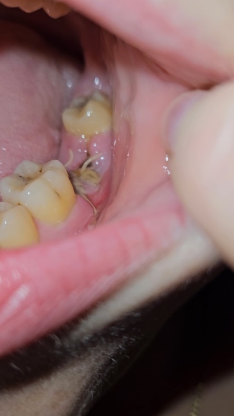 Tooth extraction
