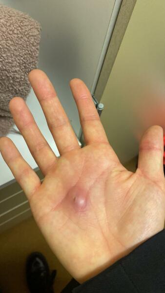Hand infected (Warning, gross photos)