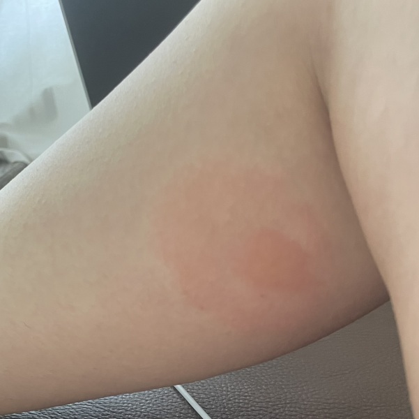Does this look like a Bullseye rash (Lyme) to you ? (Pregnant)