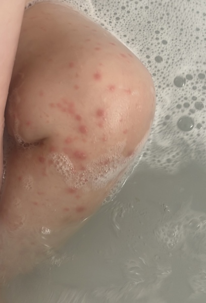 Is this chicken pox?