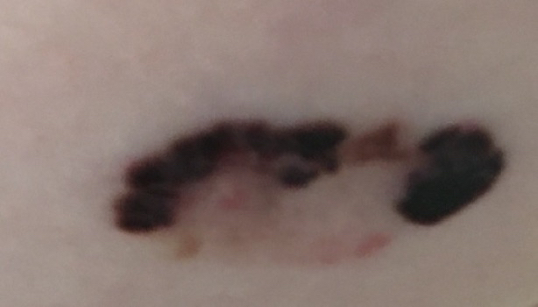 “Melanoma” - hopefully a stupid question!