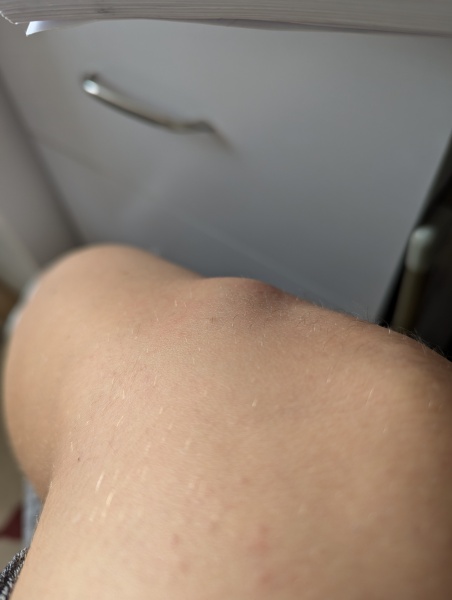 Anyone had an insect bite go hard like this?