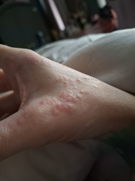 Hand infected (Warning, gross photos)