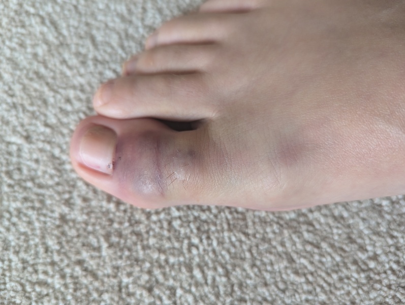 How do you know if you have broken big toe?