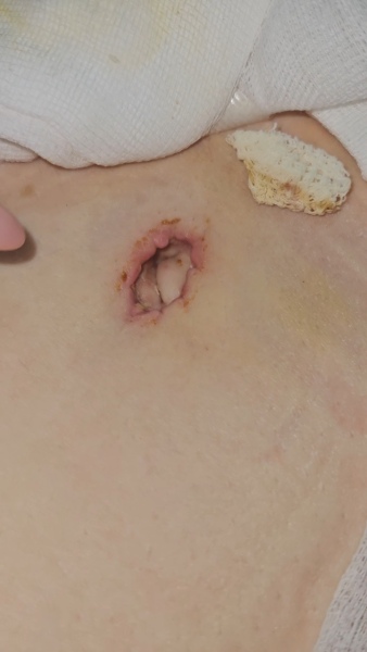 Tummy tuck *slightly graphic image* (edited by MNHQ)