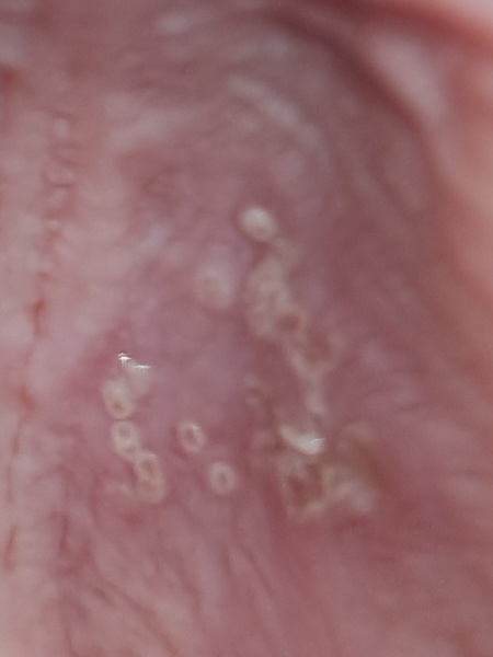 Is this Canker sores? Pic attached