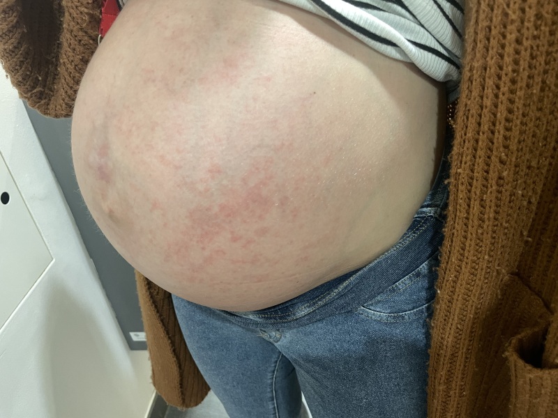 PUPPP pregnancy rash