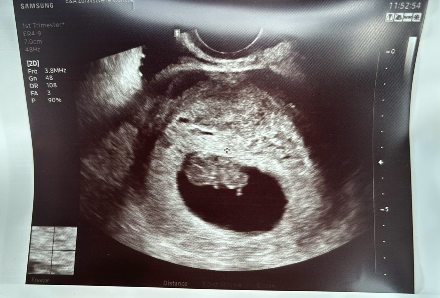 BFP after IVF - the journey continues (part 2)