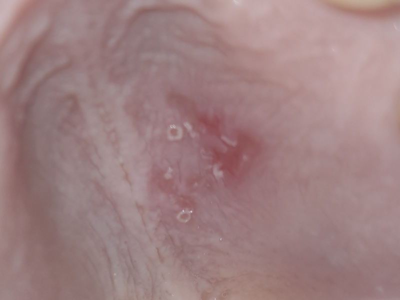 Is this Canker sores? Pic attached