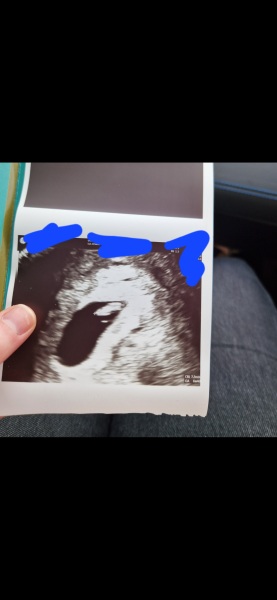 6 week scan - What to expect?
