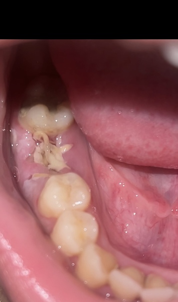 Tooth Extraction Healing