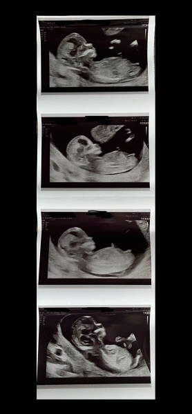 Girl or boy??? 12 week scan