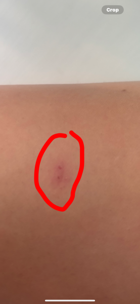 Does this look like a spider bite?