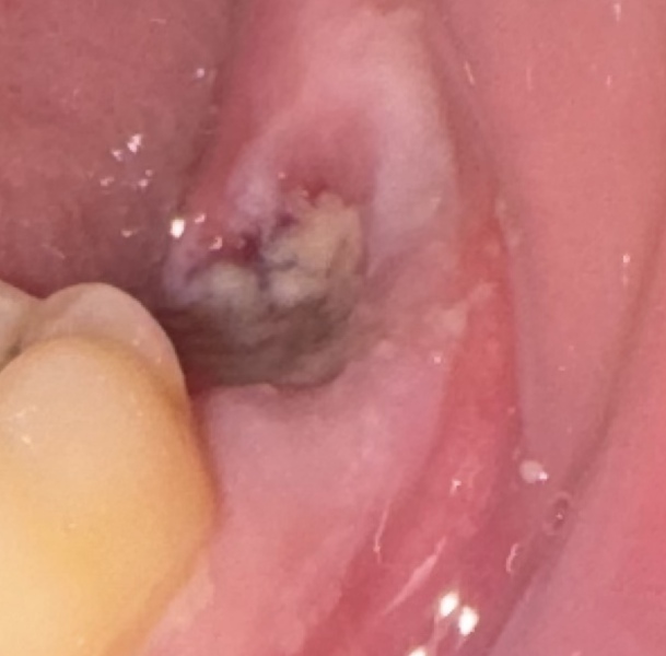 Is my tooth extraction healing ok?