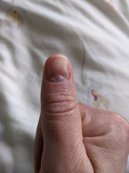 Help pls, possible autoimmune