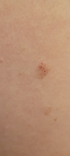 Could this be melanoma?