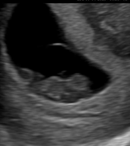 Concerned! Weird shaped gestational sac at first ultrasound