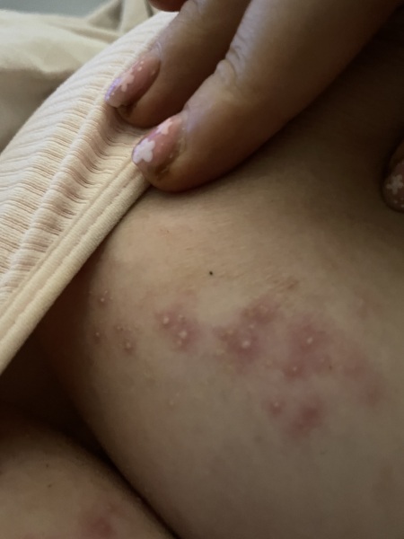 Spotty looking rash between breasts