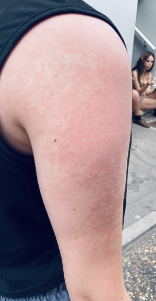 What might cause this rash on the beach?