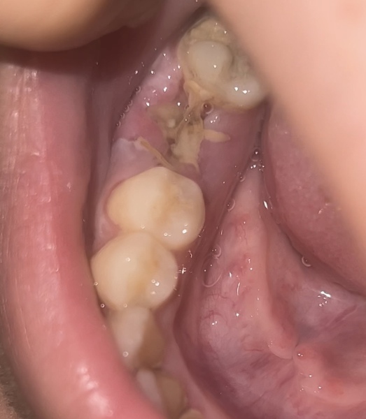 Tooth Extraction Healing