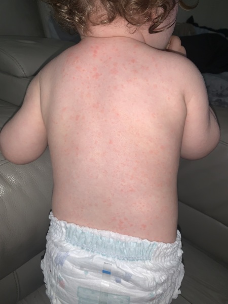 MMR jab and mini measles