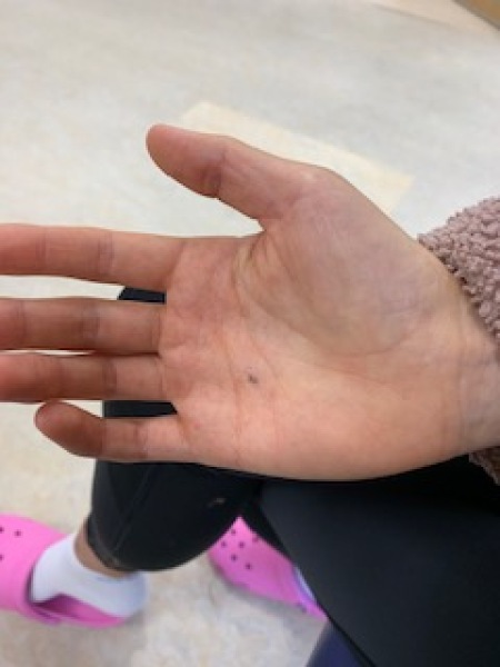 Hand infected (Warning, gross photos)