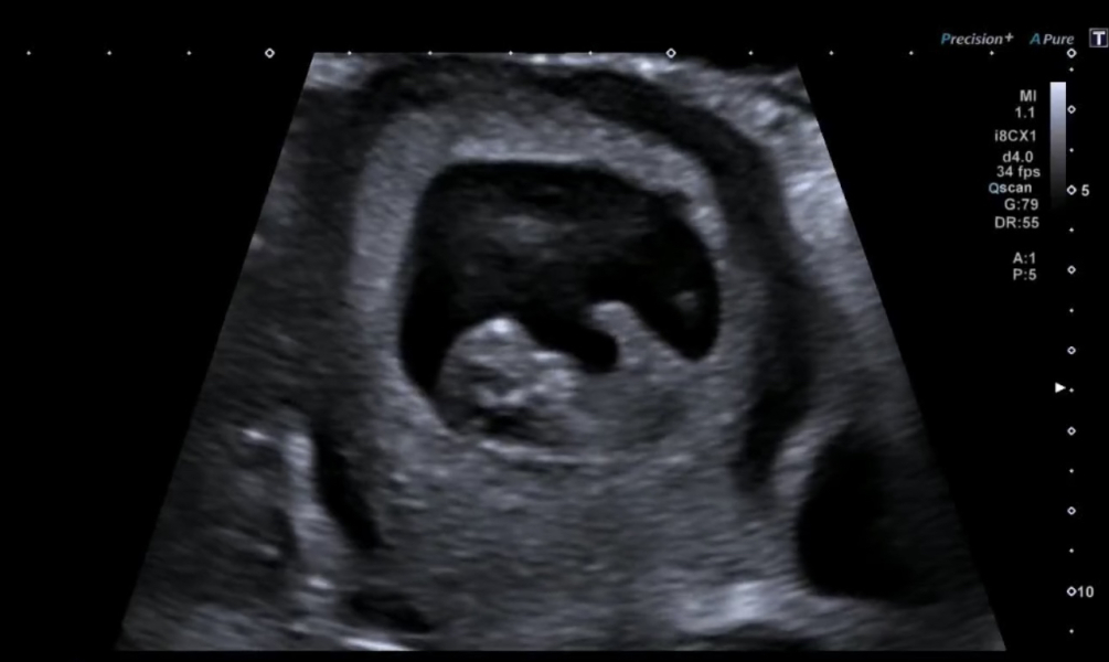 No symptoms/symptom loss in pregnancy